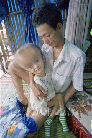 Trong ảnh: Anh Trần Quang Thân, ở chợ Đầm Nha Trang, chuyên làm nghề đào bới phế liệu, chủ yếu ở các khu quân sự Mỹ ngụy trước đây nên đã bị nhiễm chất độc da cam/dioxin. Hậu quả là con của anh bị dị dạng, mất trí (2000). Ảnh: Ngô Mỹ - TTXVN