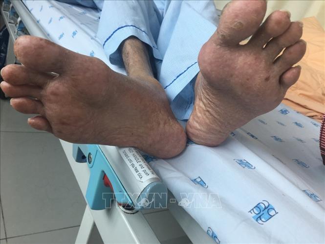 Trong ảnh: Biểu hiện nhiễm độc thạch tín ở bàn chân của bệnh nhân. Ảnh: TTXVN phát