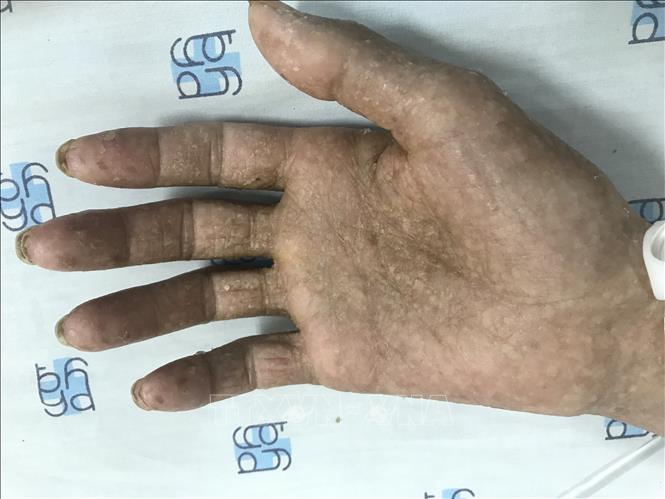 Trong ảnh: Biểu hiện nhiễm độc thạch tín ở bàn tay của bệnh nhân. Ảnh: TTXVN phát