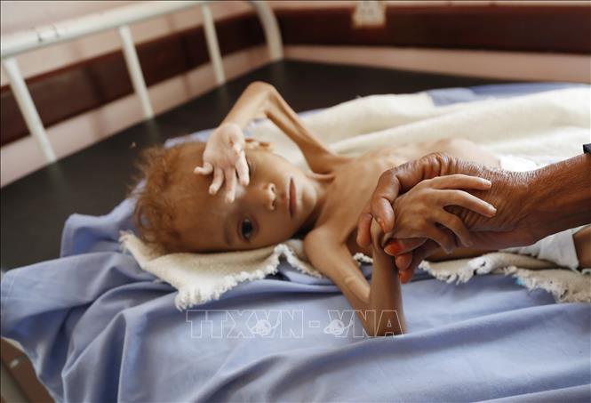 Trong ảnh: Trẻ em suy dinh dưỡng được điều trị tại bệnh viện ở tỉnh Hajjah, Yemen. Ảnh: THX/ TTXVN