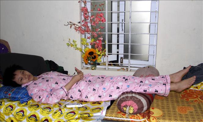 Trong ảnh: Bệnh nhân Hoàng Phương Anh (19 tuổi) bị viêm cột sống dính khớp, từ vai trở xuống bị sơ cứng, không hoạt động được, xương khớp rất đau, nhức mỏi đang điều trị tại Trung tâm. Ảnh: Trịnh Bang Nhiệm - TTXVN