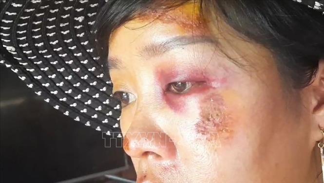 Trong ảnh: Chị Hạnh với nhiều vết thương ở mặt sau khi bị hai tên cướp đạp ngã, giật túi xách. Ảnh: Đậu Tất Thành - TTXVN
