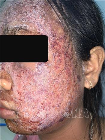Trong ảnh: Da mặt thiếu nữ 17 tuổi bi hủy hoại sau khi sử dụng sản phẩm lột da sinh học không rõ nguồn gốc. Ảnh: TTXVN phát