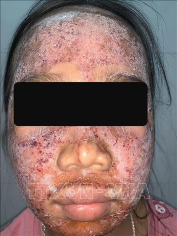Trong ảnh: Da mặt thiếu nữ 17 tuổi bi hủy hoại sau khi sử dụng sản phẩm lột da sinh học không rõ nguồn gốc. Ảnh: TTXVN phát