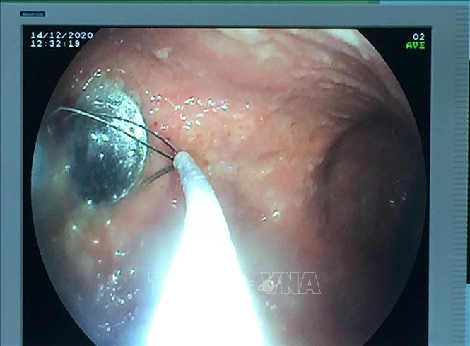 Trong ảnh: Nội soi gắp đồng xu ra khỏi cơ thể bé gái 4 tuổi nuốt phải trong lúc chơi đùa. Ảnh: TTXVN phát