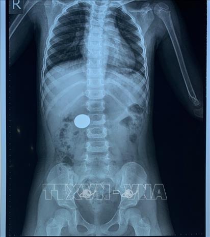 Trong ảnh: Phim chụp phát hiện đồng xu trong cơ thể bé gái 4 tuổi do nuốt phải trong lúc chơi đùa. Ảnh: TTXVN phát