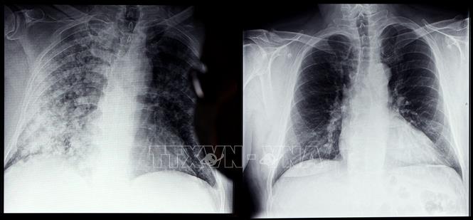 Trong ảnh: Phim chụp Xquang phổi của bệnh nhân COVID-19 (trái) và phổi của người bình thường tại bệnh viện ở Magdeburg, miền đông nước Đức, ngày 28/4/2021. Ảnh: AFP/ TTXVN