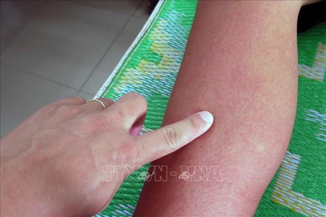 Trong ảnh: Sốt xuất huyết nặng có biểu hiện phát ban đỏ toàn thân. Ảnh: Xuân Triệu – TTXVN                           