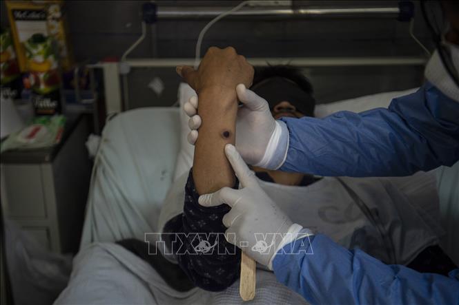Trong ảnh (tư liệu): Nốt đậu mùa khỉ trên tay một bệnh nhân tại bệnh viện ở Lima, Peru, ngày 16/8/2022. Ảnh: AFP/ TTXVN