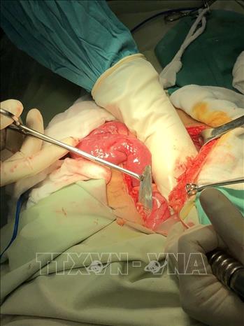 Bác sĩ Bệnh viện Đa khoa tỉnh Bạc Liêu, phẫu thuật lấy lưỡi dao trong bụng bệnh nhân  Lưu Kỳ Sang. Ảnh: Tuấn Kiệt – TTXVN.