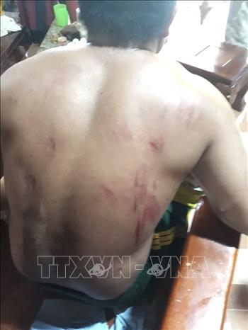 Anh Lê Văn Liêm ,34 tuổi, ngụ ấp 3, xã Thanh Sơn bị voi rừng tấn công khiến chấn thương nặng, gãy chân, trầy xước cơ thể. Ảnh: TTXVN phát 