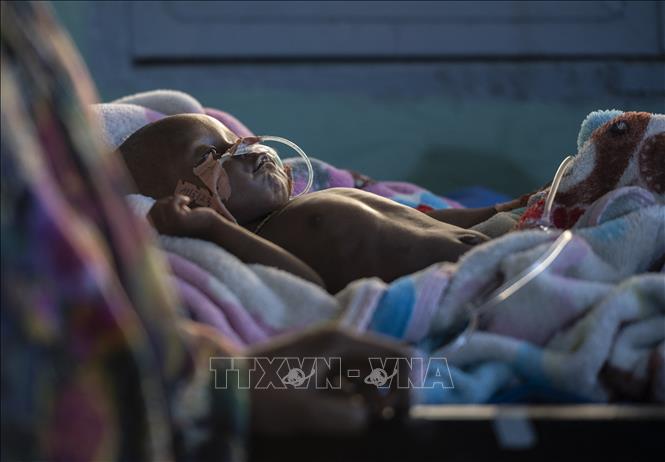Em nhỏ bị suy dinh dưỡng được điều trị tại bệnh viện ở N'djamena, CH Chad. Ảnh: AFP/TTXVN