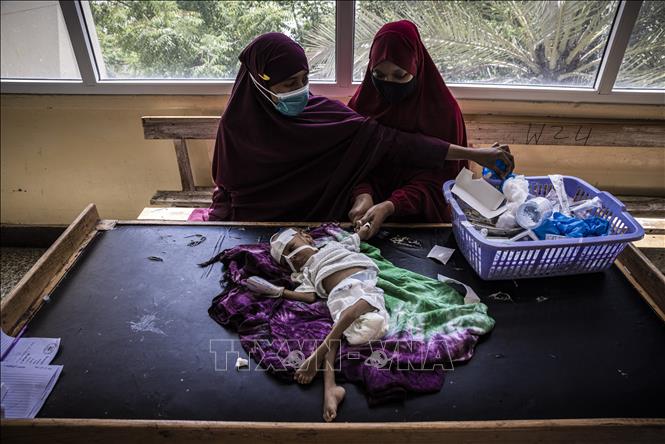 Em nhỏ bị suy dinh dưỡng được điều trị tại bệnh viện ở Mogadishu, Somalia. Ảnh: AFP/TTXVN