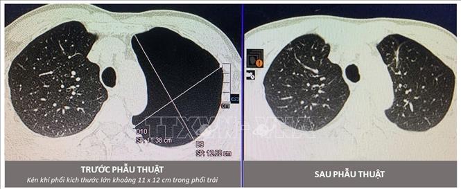 Hình ảnh kén khí phổi kích thước hiếm gặp trong lồng ngực bệnh nhân trước và sau phẫu thuật. Ảnh: TTXVN phát