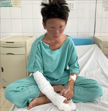 Em T.T.B, ngụ tại huyện Trảng Bom (Đồng Nai), bị bỏng vùng tay, mặt, cổ do chế pháo nổ. Ảnh: Lê Xuân - TTXVN