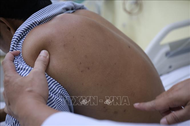 Vết ong đốt trên người bệnh nhân. Ảnh: Chanh Đa-TTXVN