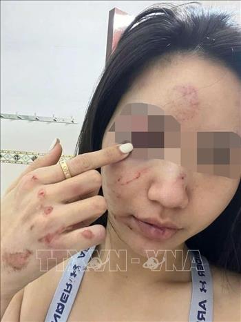 Các vết thương trên mặt chị N. sau khi bị đánh. Ảnh: TTXVN phát