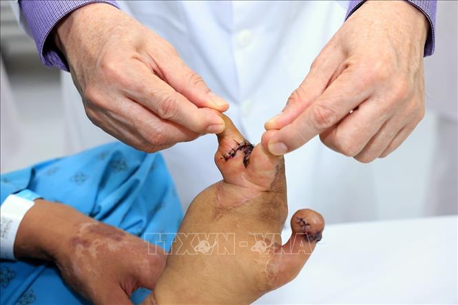 Một ca phẫu thuật chuyển phức hợp 2 ngón chân phục hồi các ngón tay. Ảnh: Tuấn Anh - TTXVN