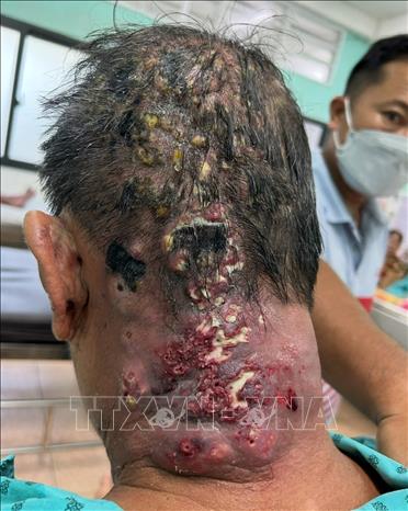 Một bệnh nhân mắc zona thần kinh bị nhiễm trùng nặng do sử dụng phương pháp 