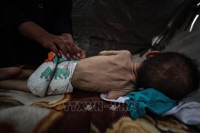 Em nhỏ bị suy dinh dưỡng, tại trại tị nạn ở Gaza, ngày 28/5/2025. Ảnh: THX/TTXVN