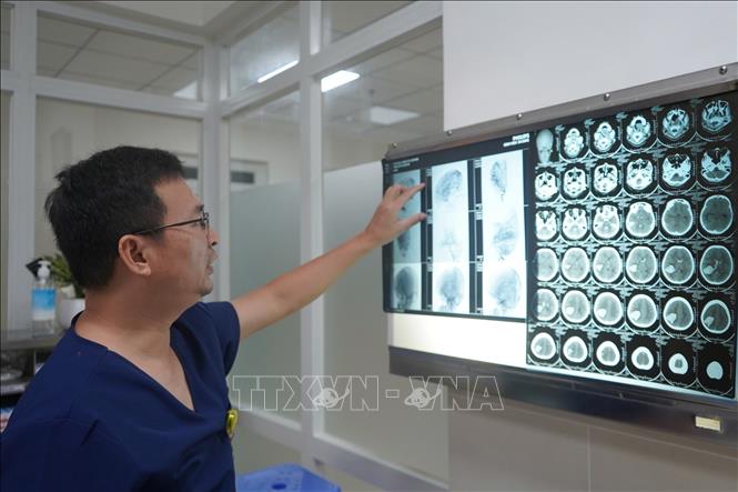 Hình ảnh dị dạng mạch máu não trước phẫu thuật. Ảnh: TTXVN phát
