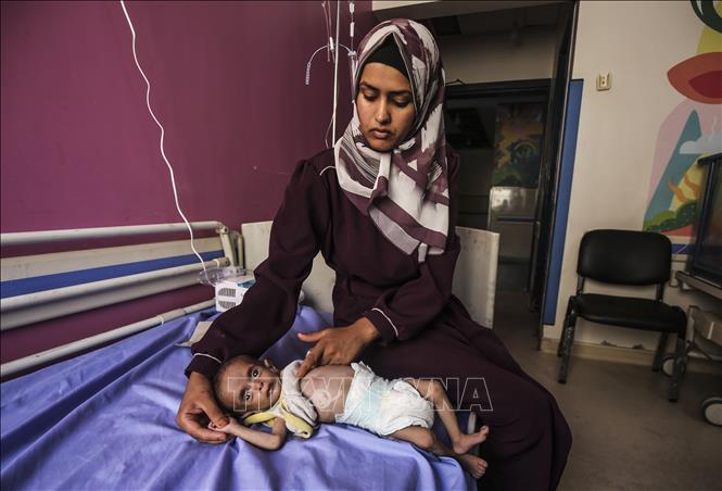 Điều trị cho em nhỏ bị suy dinh dưỡng tại Bệnh viện nhi đồng Abdulaziz er-Rantisi ở thành phố Gaza, ngày 24/7/2025. Ảnh: Anadolu Agency/TTXVN