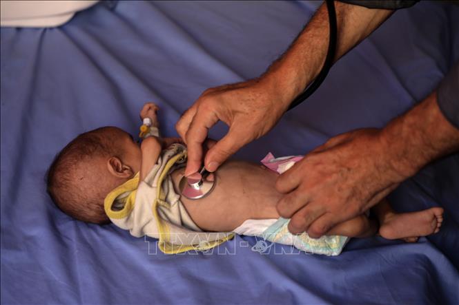 Em nhỏ bị suy dinh dưỡng được điều trị tại bệnh viện ở Gaza. Ảnh: THX/TTXVN