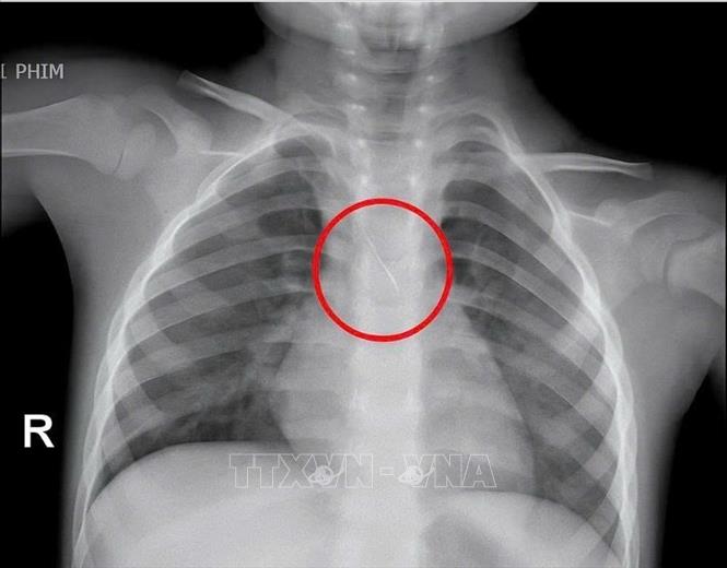 Hình ảnh chiếc kim chọc tuỷ rơi vào trong đường thở của bé trai 3 tuổi. Ảnh: TTXVN phát