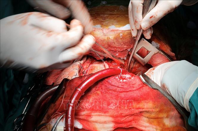 Ca ghép diễn ra trong 8 giờ, đem lại hy vọng sống mới cho nam người bệnh (31 tuổi) mắc suy hô hấp mạn tính/giãn phế quản bội nhiễm lao phổi cũ. Ảnh: Minh Quyết – TTXVN