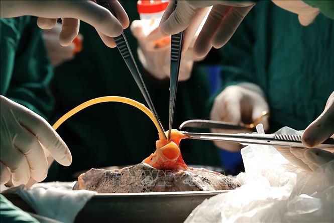 Toàn bộ các ca ghép phổi do Bệnh viện Phổi Trung ương thực hiện đều thành công ở mức cao nhất theo tiêu chuẩn của Trung tâm Ghép phổi UCSF – Trường đại học California, tại San Francisco, Trung tâm Y học uy tín nhất tại Hoa Kỳ. Hiện tại, Bệnh viện đã thực hiện thành công 12 ca ghép phổi, đưa Việt Nam vào danh sách của những Trung tâm Ghép phổi lớn trên thế giới. Ảnh: Minh Quyết – TTXVN
