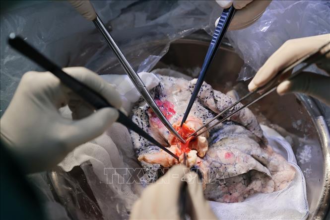 Khi đến nơi, ngay lập tức Ê kíp tiến hành kiểm tra, rửa phổi và ghép cho bệnh nhân. Ảnh: Minh Quyết -–TTXVN