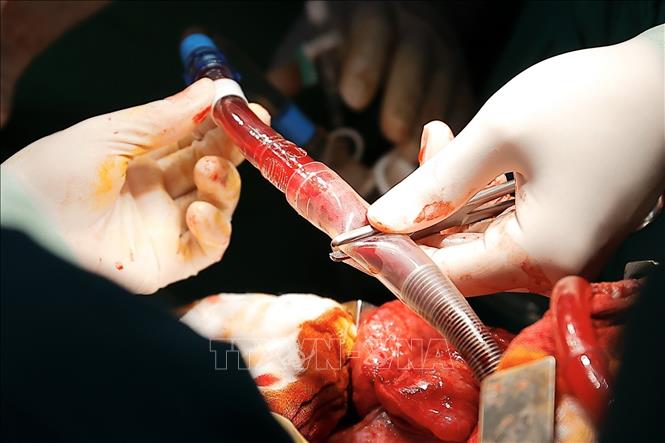 Đặt ECMO là kỹ thuật hỗ trợ tạm thời chức năng tim và phổi cho bệnh bằng cách rút máu ra ngoài, qua màng lọc cung cấp oxy và loại bỏ CO2, rồi bơm máu trở lại cơ thể. Ảnh: Minh Quyết – TTXVN