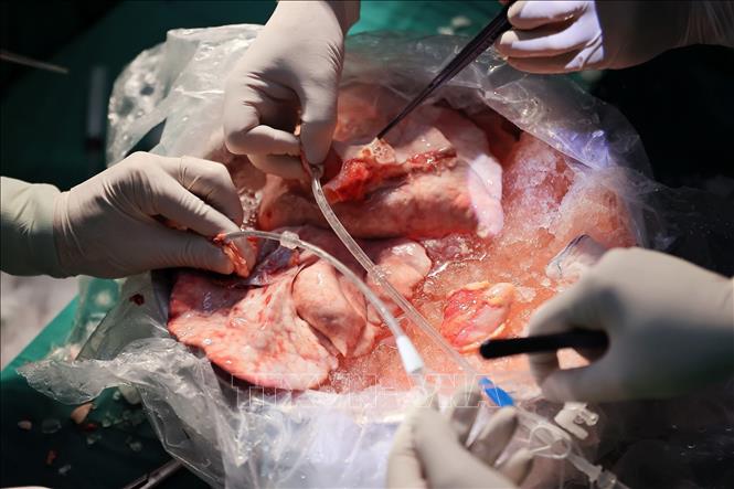 Ê kíp tiến hành kiểm tra, rửa phổi và ghép cho bệnh nhân. Ảnh: Minh Quyết - TTXVN