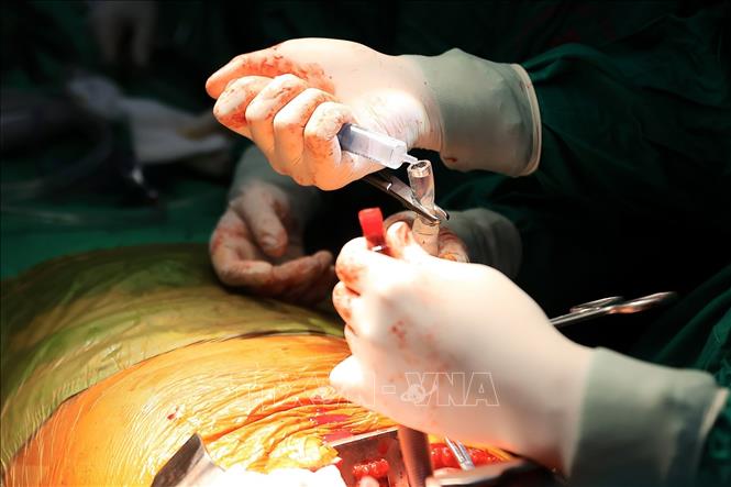 Ca ghép được thực hiện theo tiêu chuẩn chuyên môn cao nhất của UCSF Medical Center (Hoa Kỳ), với sự phối hợp chặt chẽ, đồng bộ giữa đội ngũ y bác sĩ: Bệnh viện Phổi Trung ương, Bệnh viện E, Trung tâm Điều phối ghép tạng Quốc gia, Bệnh viện Trung ương Quân đội 108, Bệnh viện Bạch Mai…Ảnh: Minh Quyết - TTXVN