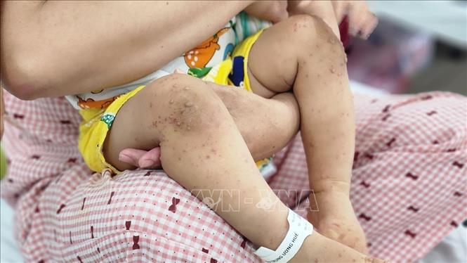 Dấu hiệu bệnh tay chân miệng xuất hiện ở trẻ. Ảnh: Mai Trang - TTXVN