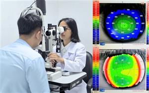 Phát hiện nhiều trường hợp giác mạc chóp ở người trẻ từ những bệnh nhân đo cắt kính thông thường