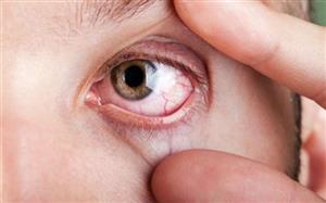 Thoái hóa giác mạc - tác động môi trường đến 