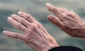 Đột phá mở đường cho điều trị cá nhân hóa bệnh Parkinson
