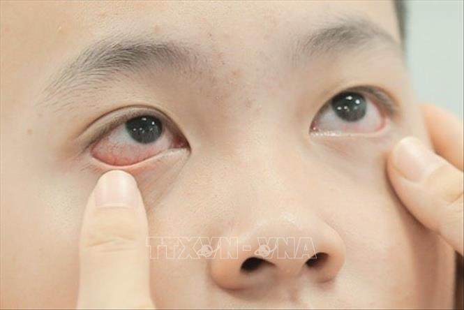 Cục Phòng bệnh lưu ý đau mắt đỏ, hay viêm kết mạc, có thể do nhiều nguyên nhân như virus, vi khuẩn, dị ứng hoặc các tác nhân kích thích. Virus Adeno là một trong những nguyên nhân thường gặp nhưng không phải tất cả trường hợp đau mắt đỏ đều do tác nhân này. Ảnh: Minh Quyết – TTXVN
