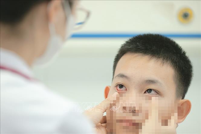 Cục Phòng bệnh lưu ý đau mắt đỏ, hay viêm kết mạc, có thể do nhiều nguyên nhân như virus, vi khuẩn, dị ứng hoặc các tác nhân kích thích. Virus Adeno là một trong những nguyên nhân thường gặp nhưng không phải tất cả trường hợp đau mắt đỏ đều do tác nhân này. Ảnh: Minh Quyết – TTXVN
