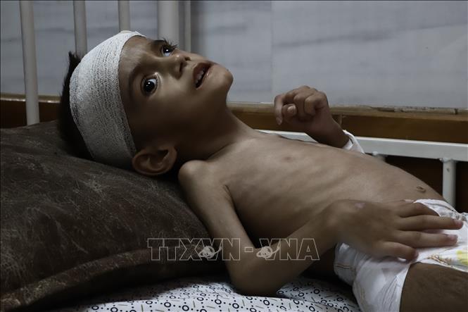 Em nhỏ bị suy dinh dưỡng được điều trị tại bệnh viện ở Gaza. Ảnh: THX/TTXVN phát