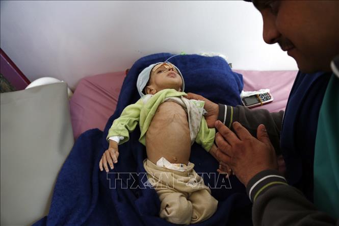 Em nhỏ bị suy dinh dưỡng được điều trị tại bệnh viện ở Sanaa, Yemen. Ảnh: THX/TTXVN phát