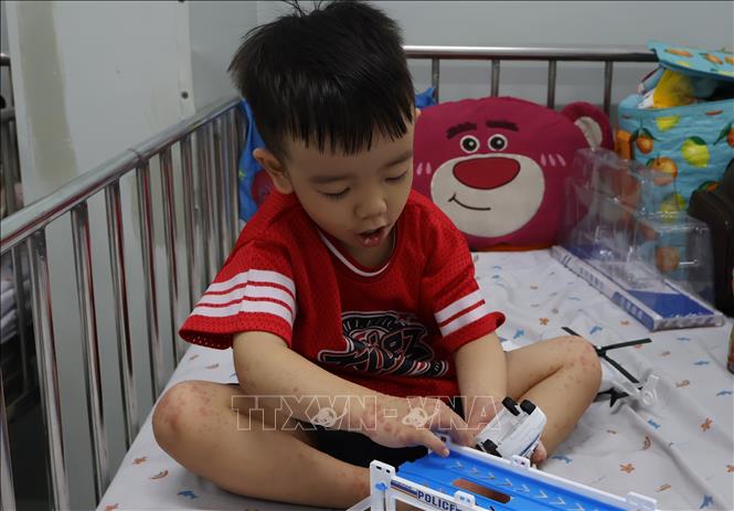 Bệnh nhi mắc tay chân miệng nổi nhiều bóng nước trên cơ thể. Ảnh: Đinh Hằng - TTXVN
